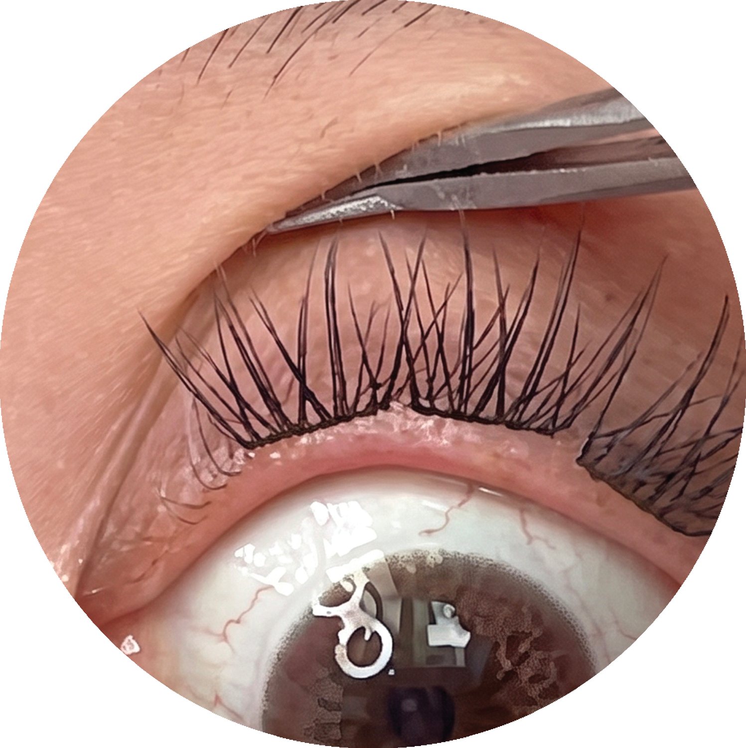 Incorrect lash placement